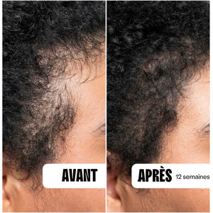 Dermaroller 0,25 mm pour Microneedling des cheveux/de la barbe - POPMYCURLS BOX PARIS